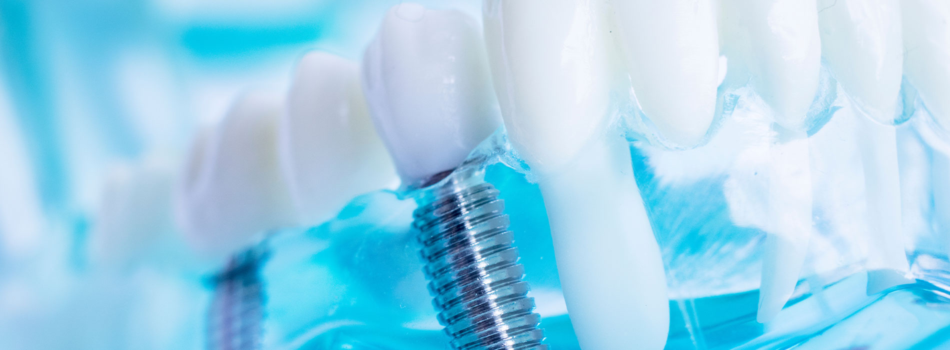 Russell D. Hatfield, DDS, MS, Ltd | Cone Beam  CBCT , IV Sedation and Dental Implants