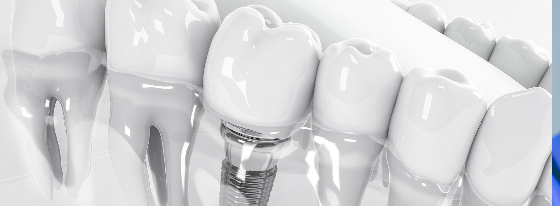 Russell D. Hatfield, DDS, MS, Ltd | Cone Beam  CBCT , Sinus Augmentation and Periodontal Exam